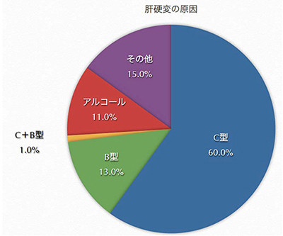 グラフ：肝硬変の原因